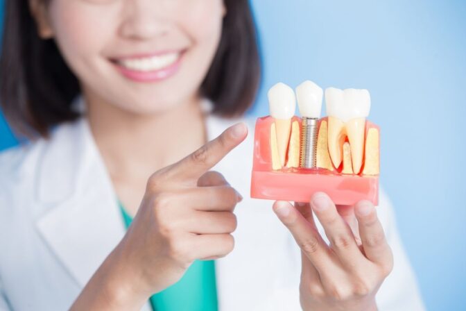 What is a dental implant and types of dental implants