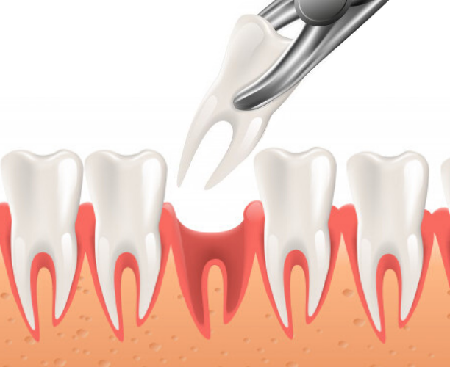 tooth-extraction-prime-dental-hospital-kushinagar