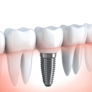 dental-implant-prime-dental-hospital-kushinagar