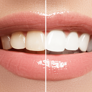 teeth-whitening-prime-dental-hospital-kushinagar