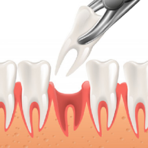 tooth-extraction-prime-dental-hospital-kushinagar